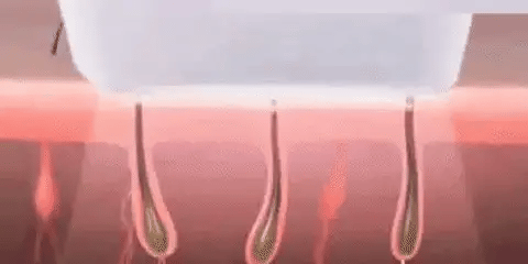 Épilation IPL – Beauté à Domicile